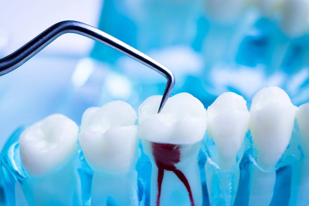 How Long Does A Root Canal Take?